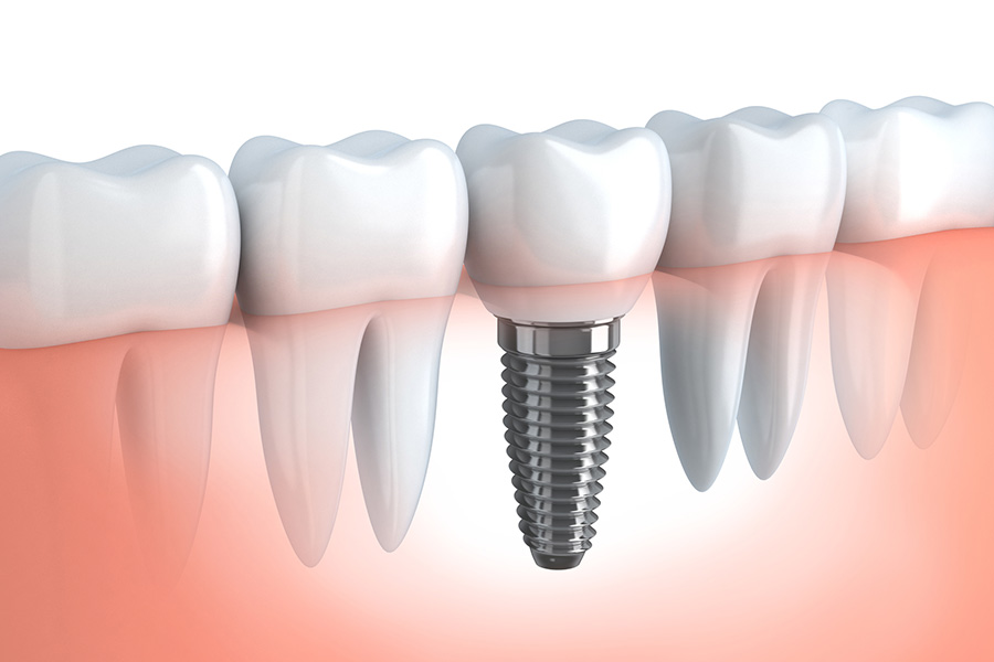 インプラント治療